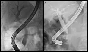 Benign Biliary Treatment in Electronic City